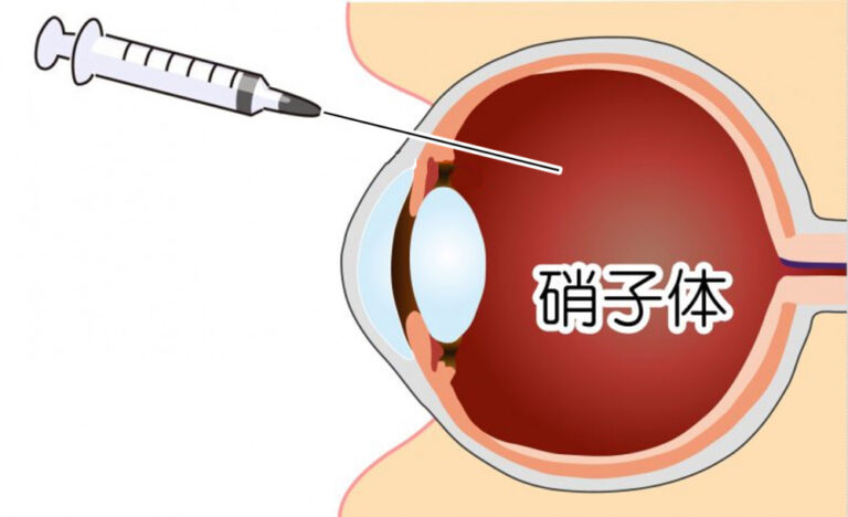 硝子体注射