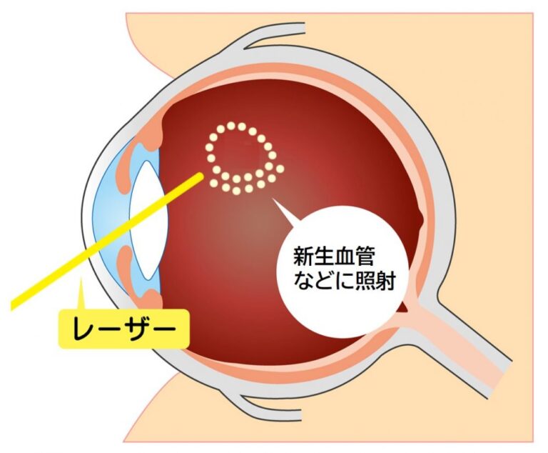 レーザー治療