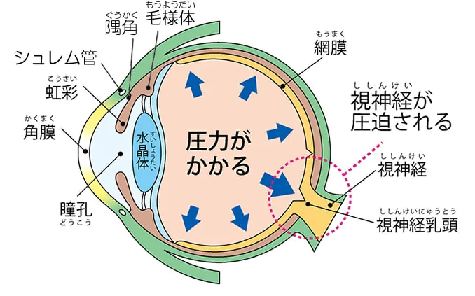 緑内障