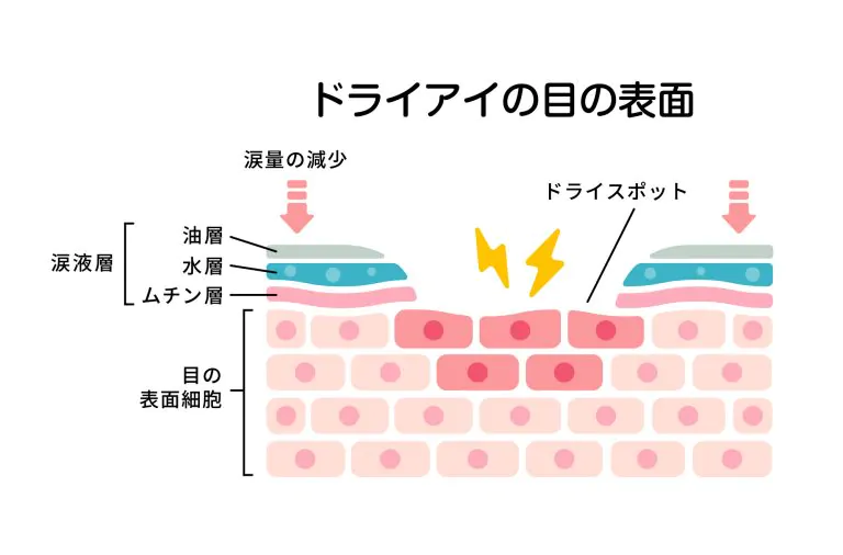 ドライアイ